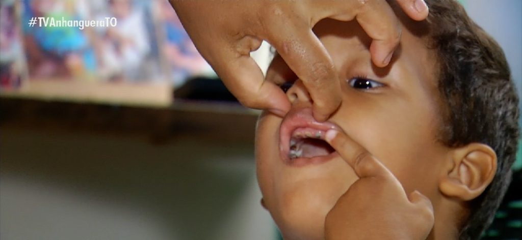 Cirurgia de menino que precisa extrair todos os dentes está marcada para a próxima semana: ‘Expectativa é a melhor’, diz mãe